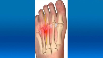 bd-hablamos-sobre-adormecimiento-de-dedos-de-pies-030920