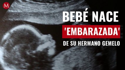 Bebé nace 'embarazada' de su hermano gemelo