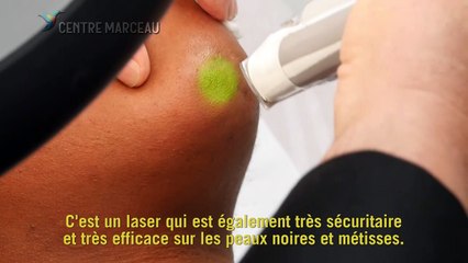 Epilation laser définitive - Quels types de laser ?