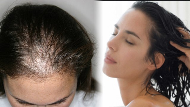 लहसुन से बाल उगाये | लहसुन से बाल बढ़ाने का तरीका | Lahsun se bal ugana | lahsun se bal badhate hain