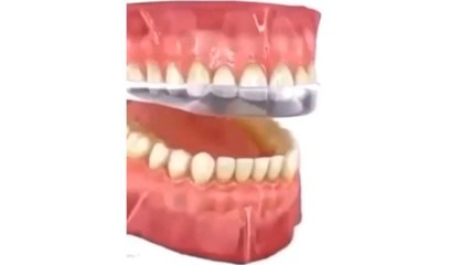 bd-tratamientos-contra-bruxismo-090920