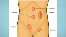 bd-cuidados-antes-y-despues-de-cirugia-de-hernias-100920