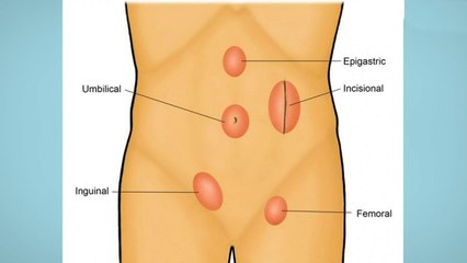 bd-cuidados-antes-y-despues-de-cirugia-de-hernias-100920