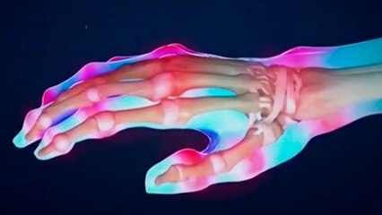 bd-causas-y-tratamientos-de-la-rigidez-articular-matutina-110920