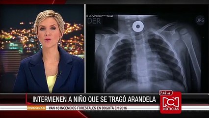 Intervención quirúrgica a menor que se tragó arandela metálica
