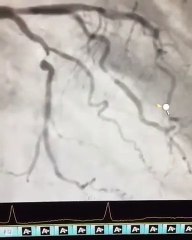 İLERİ YAŞ ANJİYO YAPILMASINA ENGEL MİDİR?