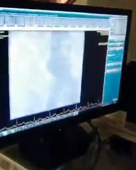 KARIN AĞRINIZI HAFİFE ALMAYIN!!! KARINDA Kİ AORT ANEVRİZMA