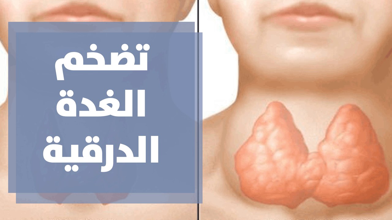 تضخم الغدة الدرقية ونقص اليود..الأسباب والأعراض