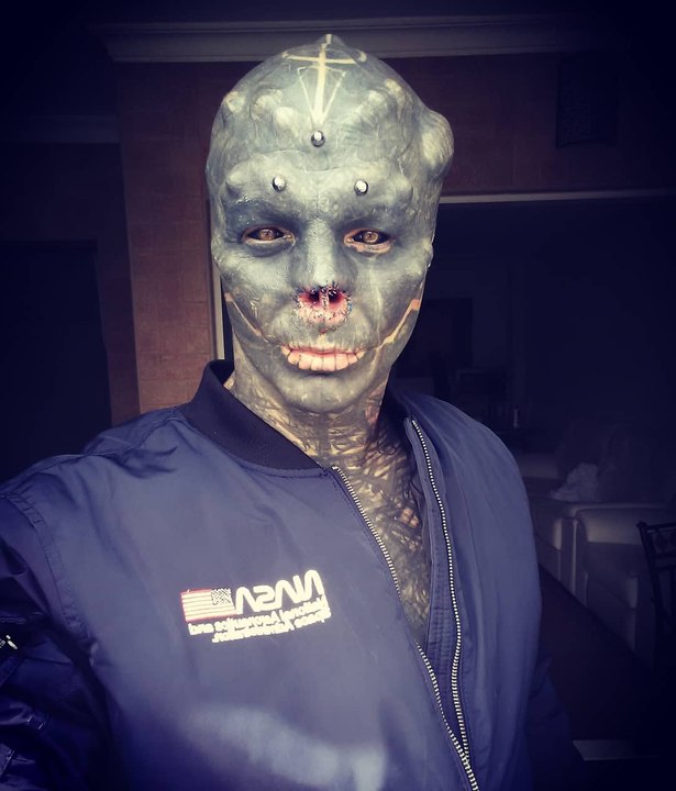 Après les oreilles, "Black Alien" se fait retirer le nez