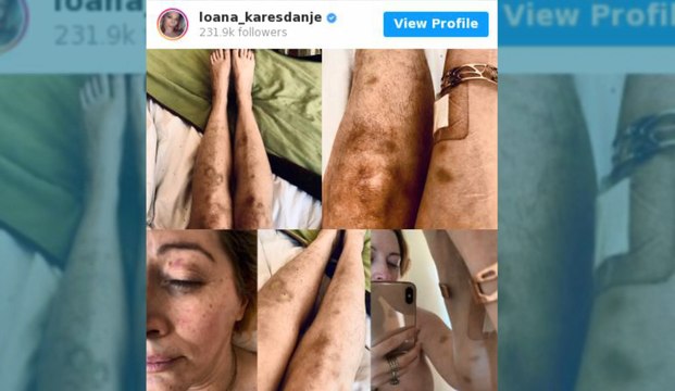 Loana publie des photos de son corps couvert de bleus et accuse son ex Fred Cauvin de l’avoir battue