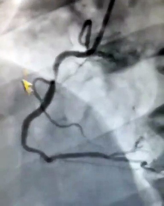 Bypass Önerilen Hastaya Stent Tedavisi ❤️