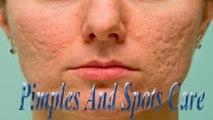 Pimples And Spots Care