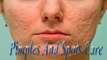 Pimples And Spots Care