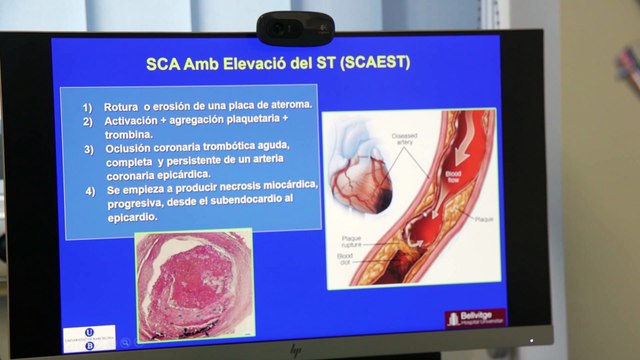9 de cada 10 pacientes con diabetes tipo 2 desconoce su riesgo cardiovascular