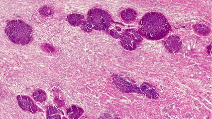 Kidney Damage Caused By COVID-19