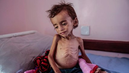 دعوة أممية  عاجلة لإنقاذ أطفال اليمن من الجوع