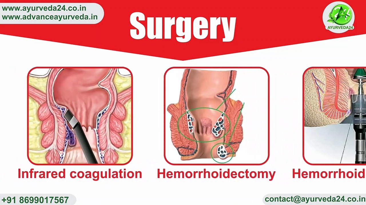 #Piles #Hemorrhoids #Ayurveda Piles | Hemorrhoids | Ayurvedic/Herbal Treatment for Piles/Hemorrhoids