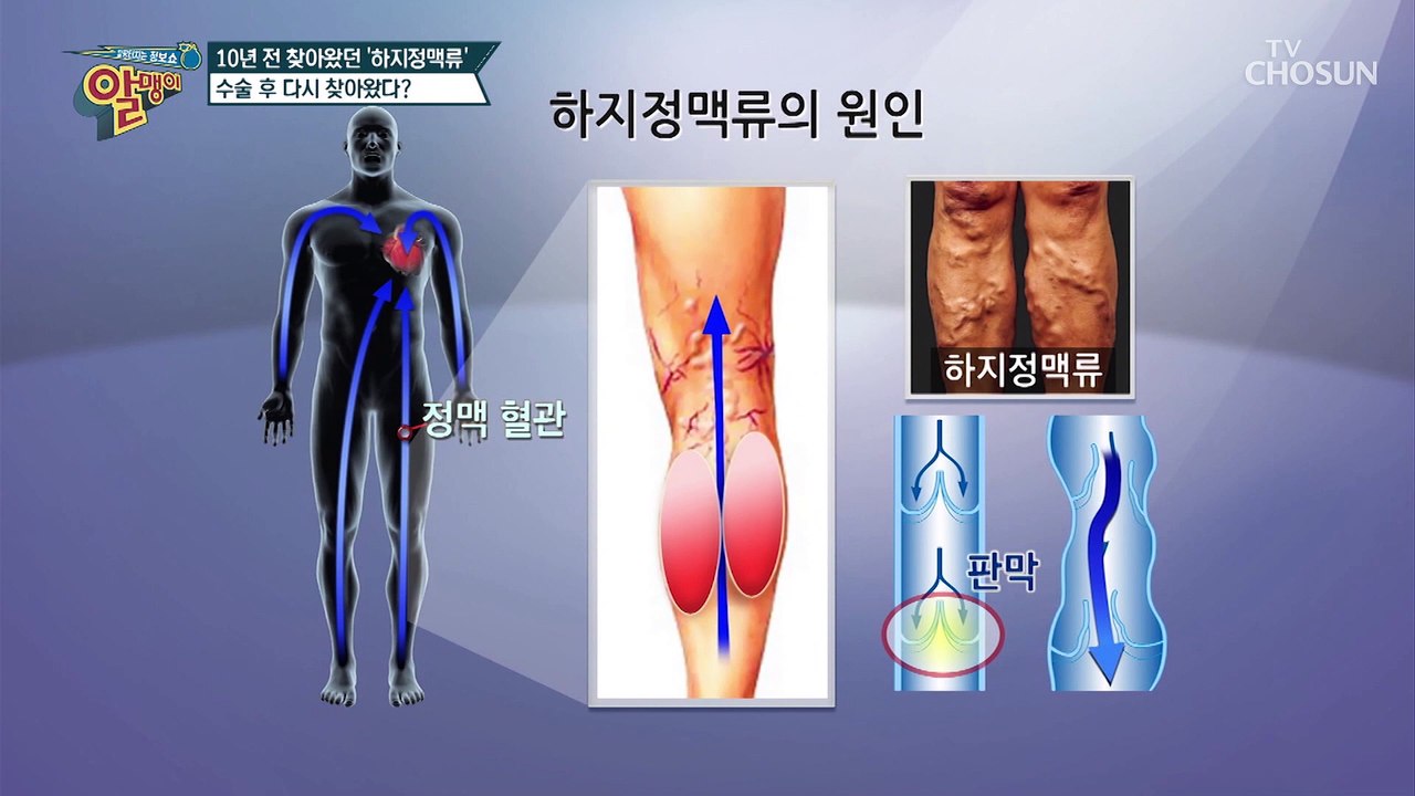 끔찍한 합병증을 유발하는 「하지정맥류」 #광고포함