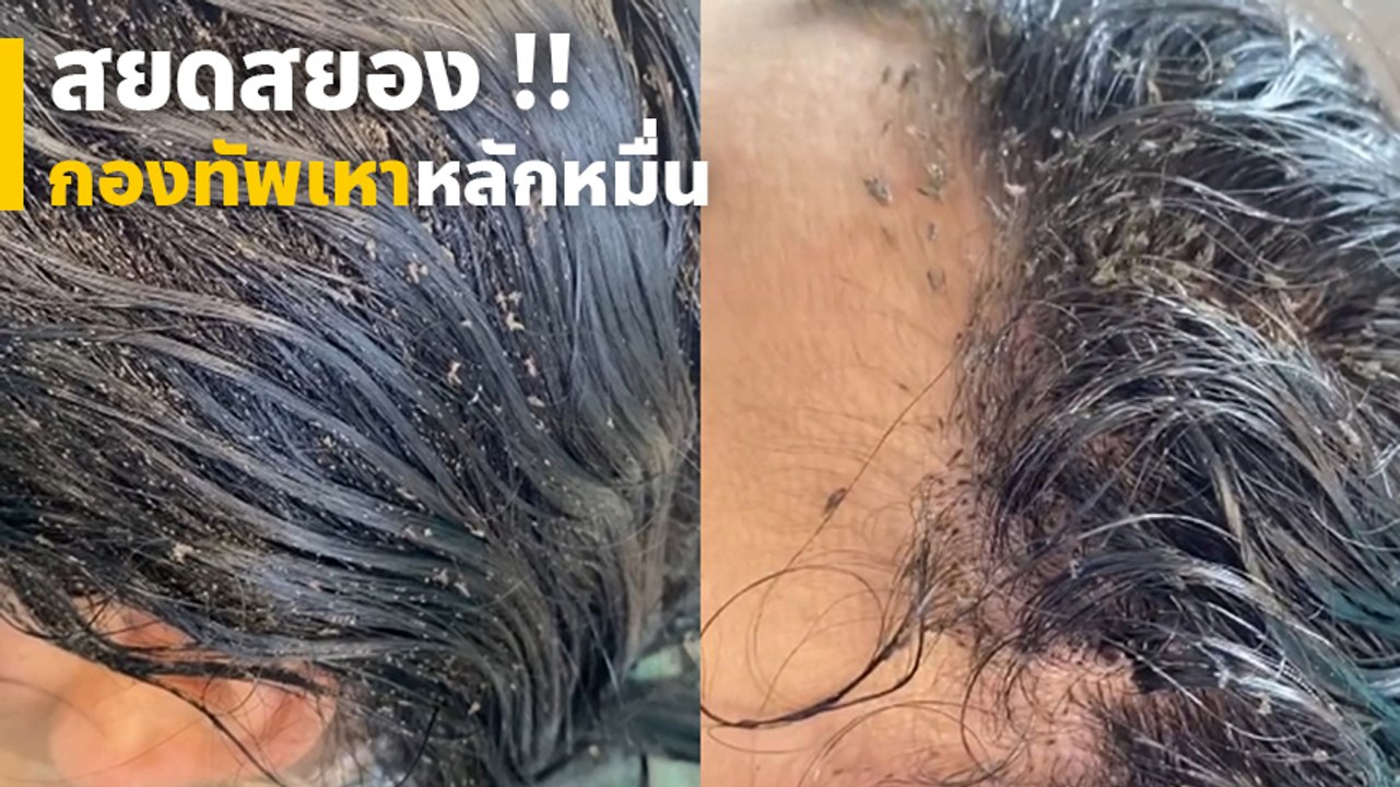 ขนลุกไปหมดเลย !! กองทัพเหาบุกหัว 15,000 ตัว+ มีใครให้สยองกว่านี้มั้ย !?