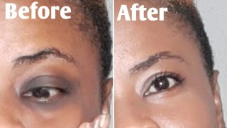 GET RID OF DARK UNDER EYE CRICLE USING THIS TWO ACTIVE INGREDIENTS