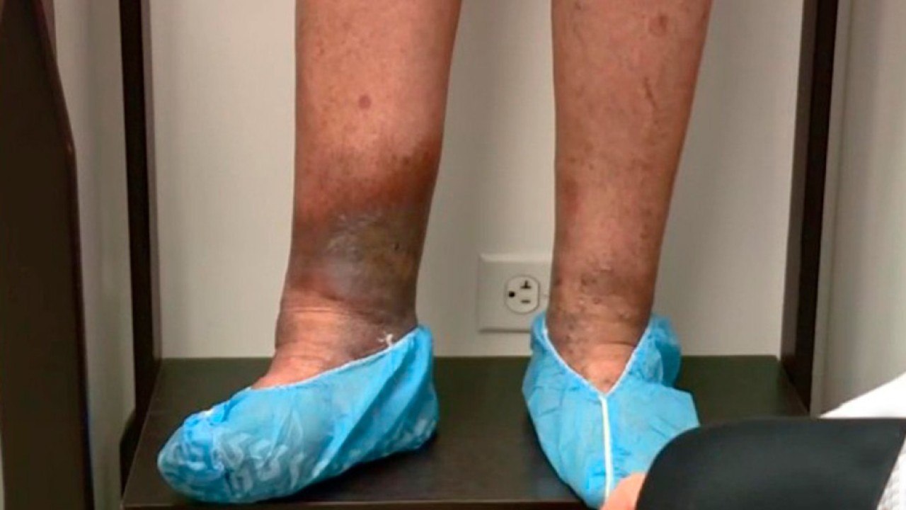 bd-consultorio-abierto-varices-y-dolor-de-piernas-021020