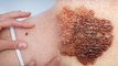 Skin Cancer की ऐसे करें पहचान, जानें क्या है Symptoms and Precautions | Boldsky