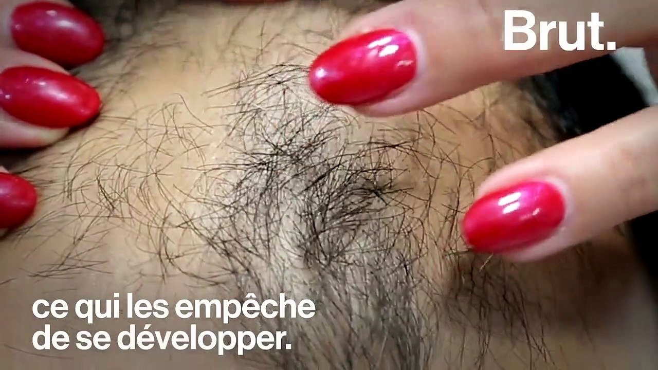 "Les gens ont tendance à me fixer parce qu'ils ne savent pas" : atteinte d'alopécie, elle témoigne