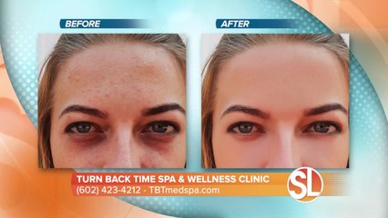 Watch how Turn Back Time Spa & Wellness Clinic can remove dark spots, age spots and much more from your skin