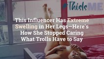 This Influencer Has Extreme Swelling in Her Legs—Here's How She Stopped Caring What Trolls