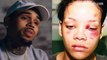 Rihanna'a Bruised Face, Black Eye Sparks Chris Brown Comments, But Real Issue Is Something Else