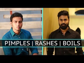 Myths and facts about Pimples, Rashes and Boils | Nurture | Say Swag