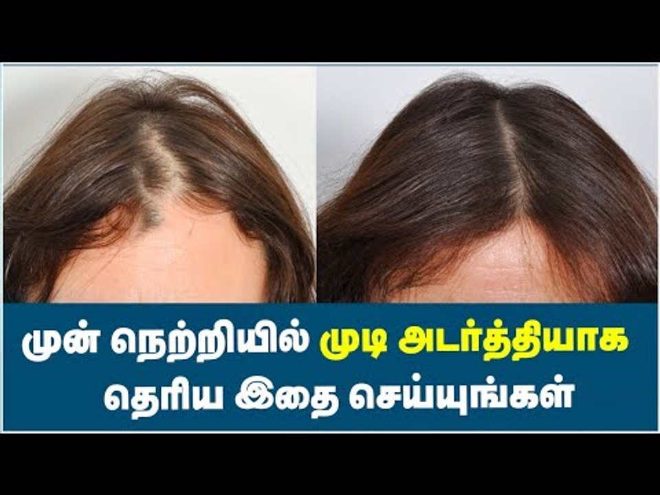Best Solution for Front Line Hair Fall ! | Front Line Hair Fixing Products  - video Dailymotion