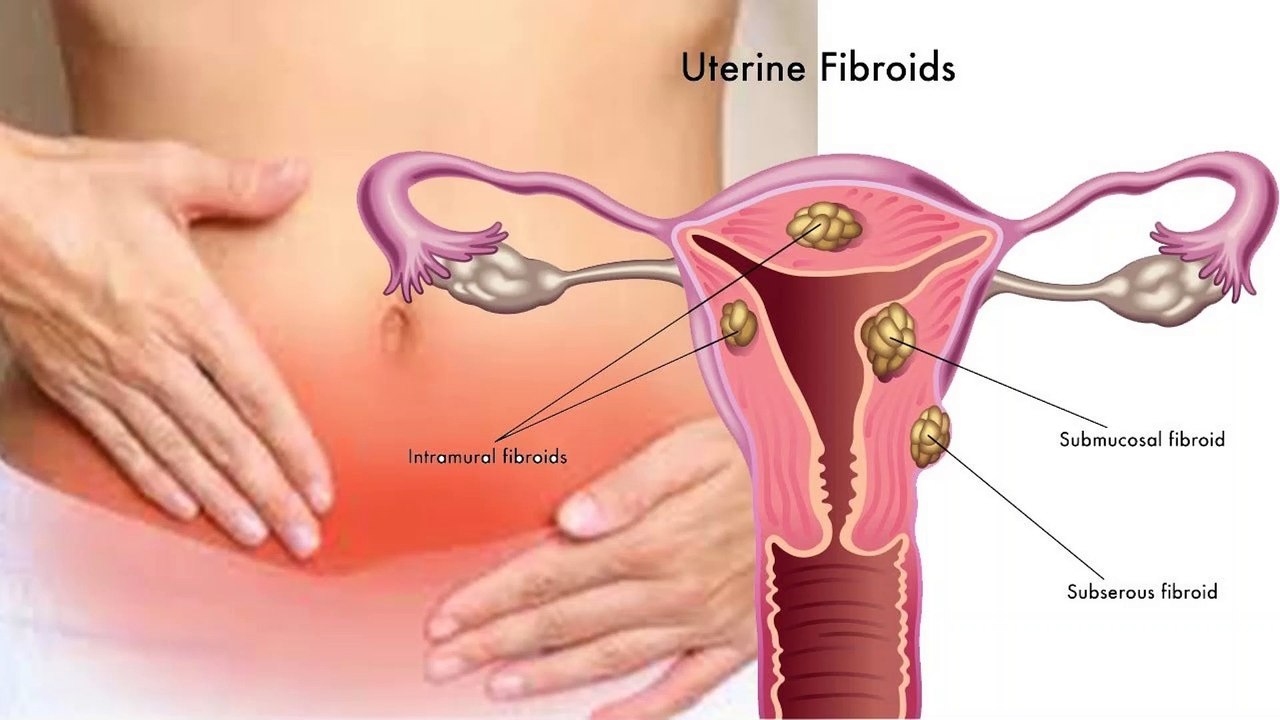 Fibroids Urdu Video