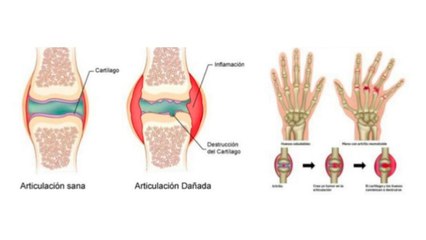 bd-como-aliviar-el-dolor-de-la-artritis-121020