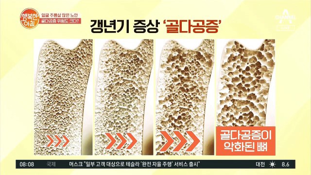 갱년기 여성 골다공증 위험도가 크다 충격적인 골밀도 차이!