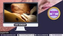 Beard Transplant in Delhi [Live], Beard Transplant Cost in Delhi, Beard Transplant by famous Cosmetic Surgeon Dr PK Talwar