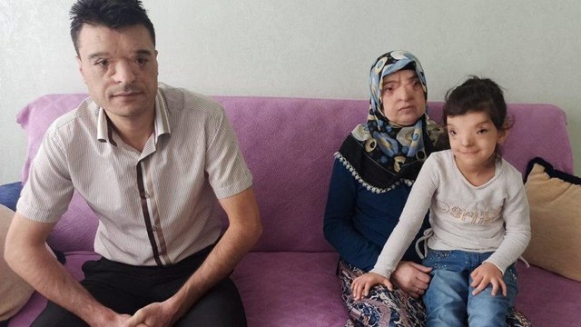 Dünyada sadece 4 ailede var: Nasopalpebral Lipoma Coloboma Sendromu