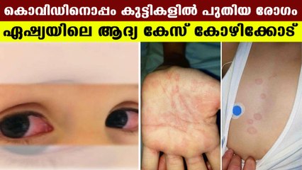 കാവസാക്കി സമാനമായ രോഗമാണ് കുട്ടികളില്‍ പടരുന്നത് | Oneindia Malayalam