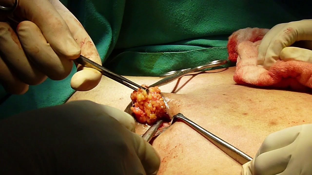 Gynaecomastia Surgery in Delhi by Dr. PK Talwar