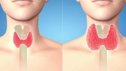 bd-cuando-es-necesario-operar-el-bocio-141020