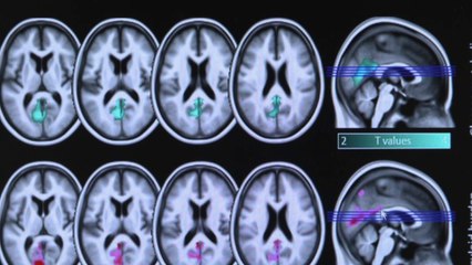 Santé - Apnée du sommeil : plus de risque d'Alzheimer