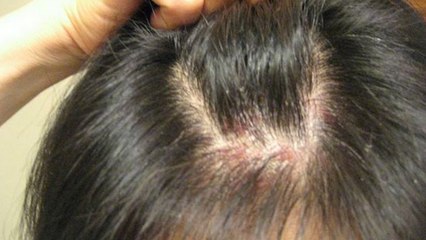 सिर में हो रहे हैं पिंप्लस तो ये घरेलू नुस्खे आएंगे काम | Scalp Pimples Home Remedies | Boldsky
