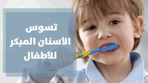 تسوس الأسنان المبكر عند الأطفال نتيجة الرضاعة