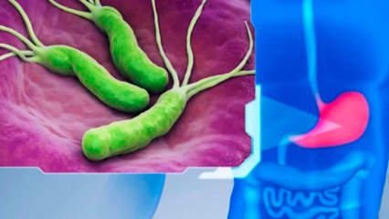 bd-como-nos-afecta-la-bacteria-helicobacter-pilory-201020