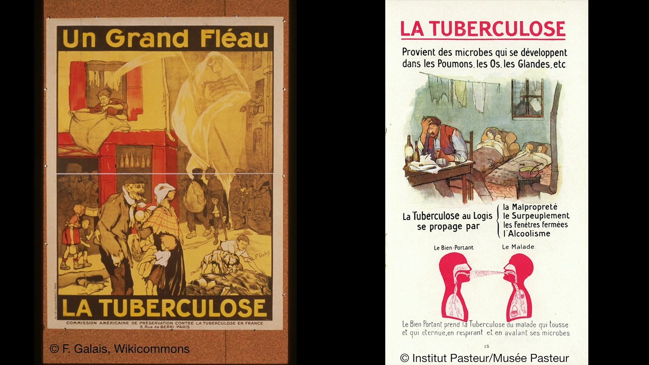 FUN MOOC : Tuberculosis