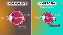 Eye defects - Hyperopia, Astigmatism, Presbyopia