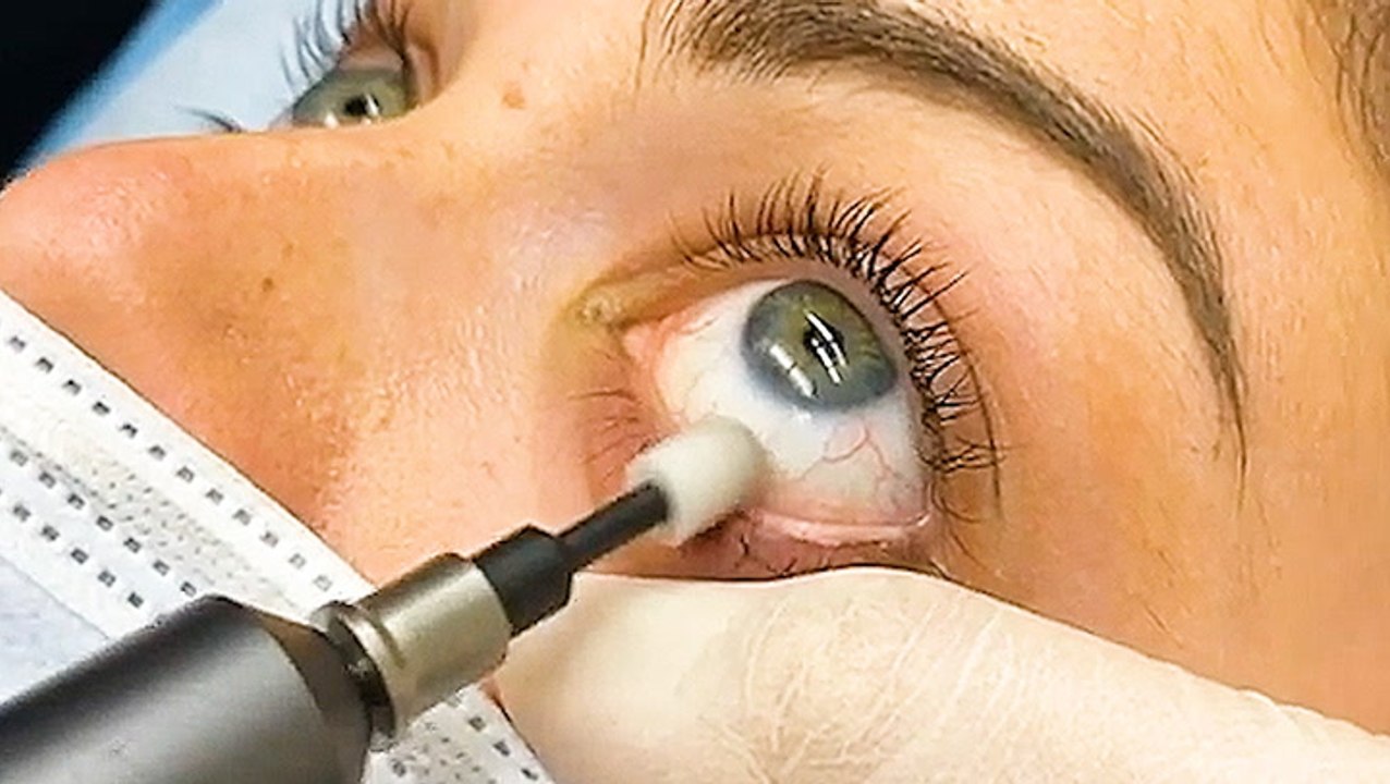 Cleanse Your Eyes With Eyelid Microexfoliation