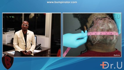 Los Angeles Man Gets Rid of Bumps On The Back Of The Head Once and For All