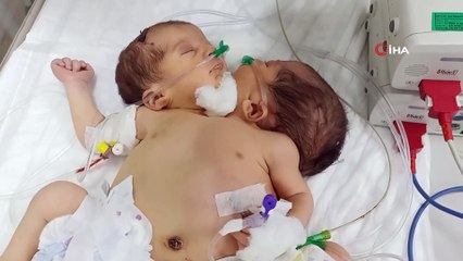 Afrinli yapışık ikizler Hatay’a getirildi