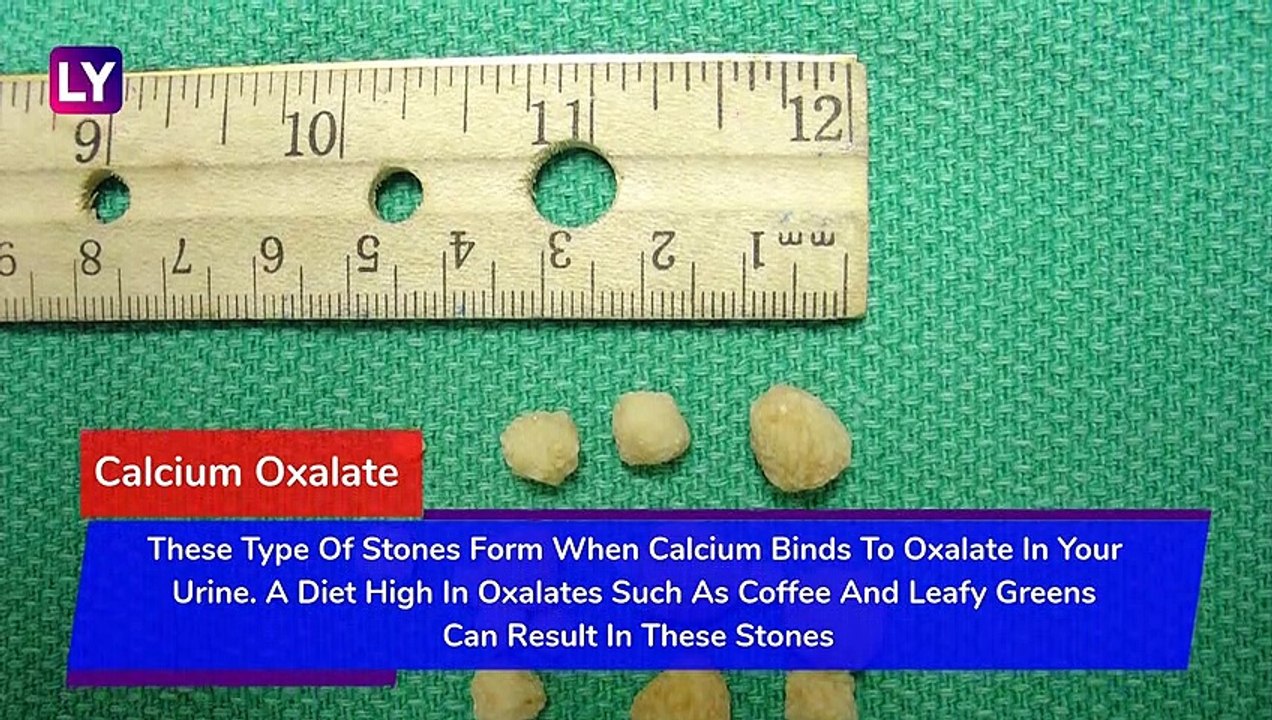 Different Types Of Kidney Stones And How To Prevent Them: World Kidney Day 2020